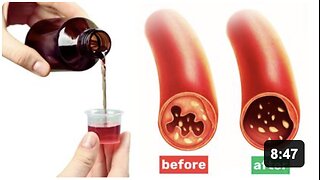 #1 SUPPLEMENT to CLEAN ARTERIES and PREVENT BLOOD CLOTS (BENEFITS OF NAC)
