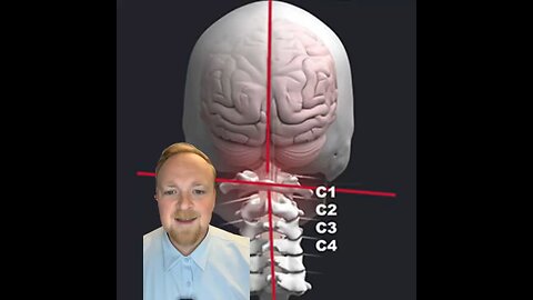 Neck trauma can be the root cause of migraine and vertigo | Neckwise upper cervical chiropractic