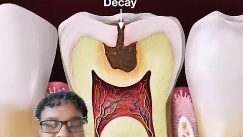 "Effective Natural Methods to Reverse Tooth Decay: Expert Advice by Dr. Kek"