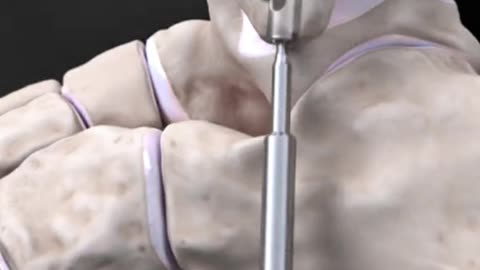 Fibula Nailing Surgery Orthopedic Surgical Procedure for Bone Fracture Fixation.