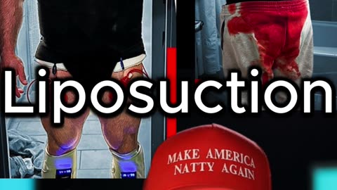 Fitness Fraud? Mike Israetel's Lipo & Steroid Scandal EXPOSED!