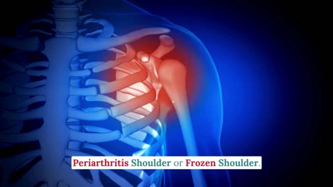 Let’s Talk Frozen Shoulder - Dr. Rangoli Tripathi - Best Physio therapy in Bommanhalli