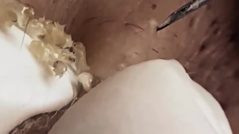 Extremely satisfying blackhead removal (ASMR) #1