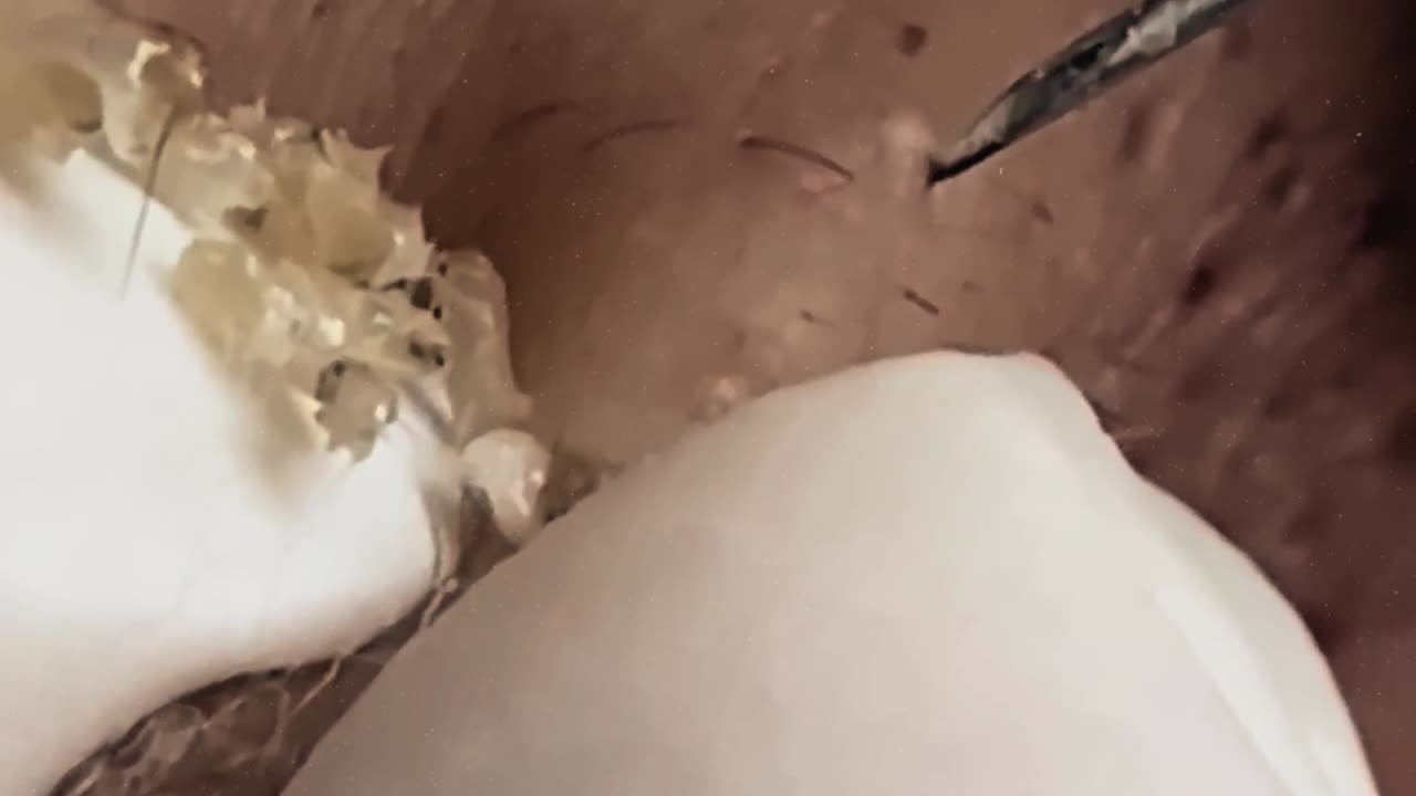 Extremely satisfying blackhead removal (ASMR) #1