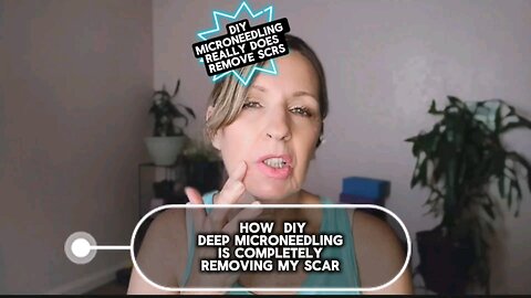 Microneedling Really Can Remove scars