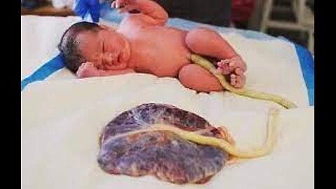 Umbilical Cord...