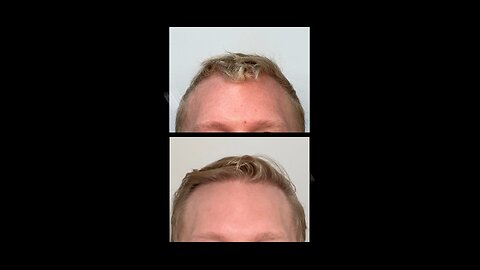 Start the new year right with a new hairline!