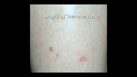 ivermectin cleared my skin cancer!