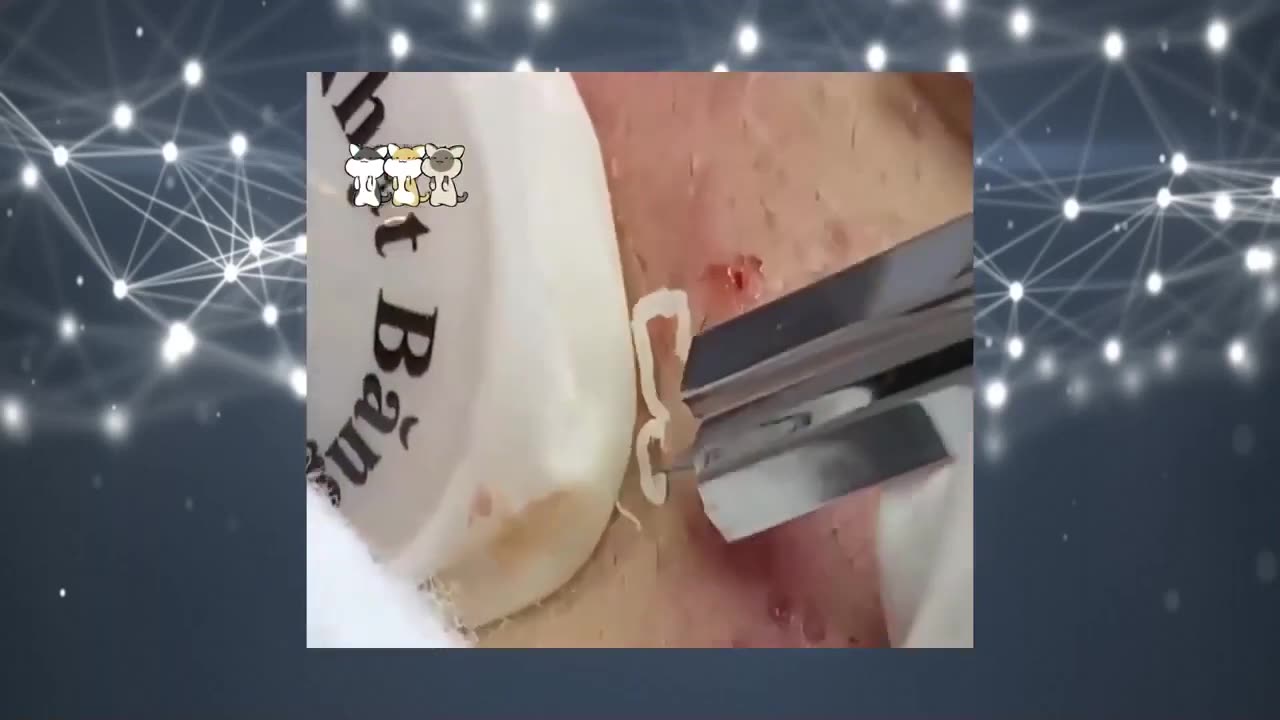Blackheads Removal & Pimple Popper Cystic Acne Extraction 215