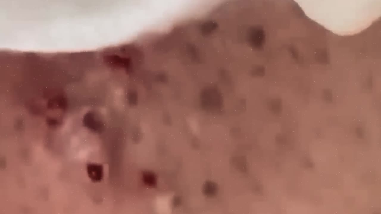 New satisfying blackhead removal (ASMR) #13