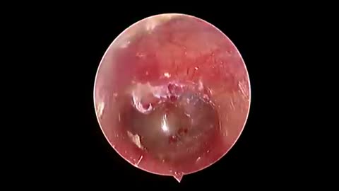 BIGGEST Earwax, Difficult Removal
