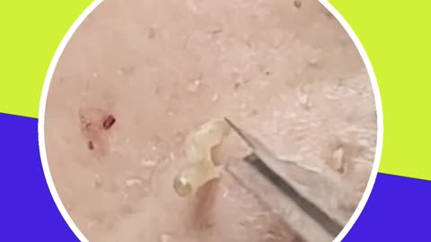 Blackhead removal new this week (ASMR) #17 #shorts