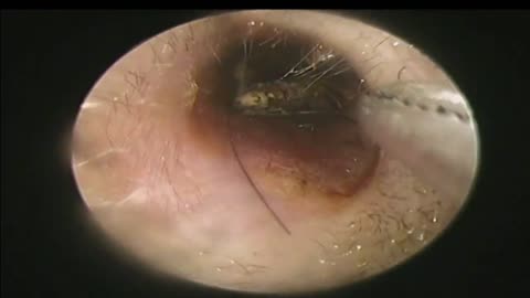 The Butterfly Died In The Ear for 1 Month