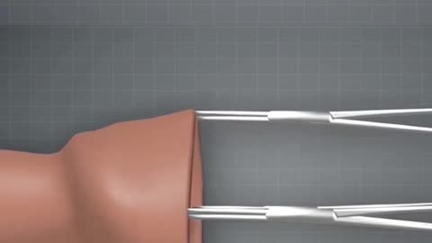 Circumcision Surgery Process 3D Animation