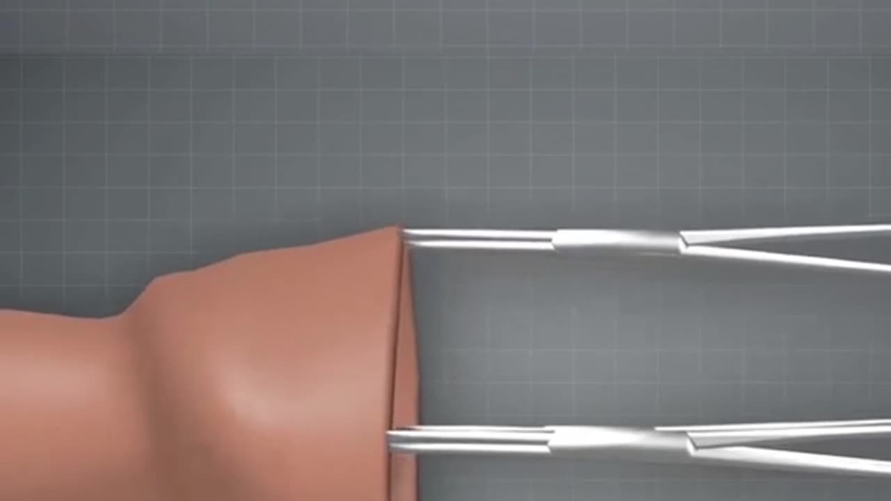 Circumcision Surgery Process 3D Animation