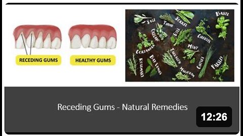 Receding Gums Natural Treatment