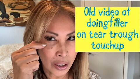 FILLER TOUCHUP ON TEAR TROUGH WITH REVOLAX FINE FROM ACECOSM