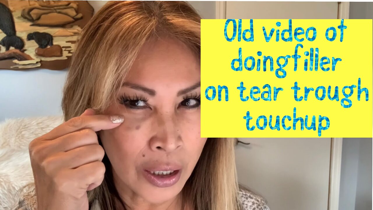 FILLER TOUCHUP ON TEAR TROUGH WITH REVOLAX FINE FROM ACECOSM