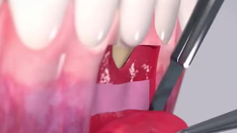 Root Coverage Of A Single Recession Deffect 3D Animation