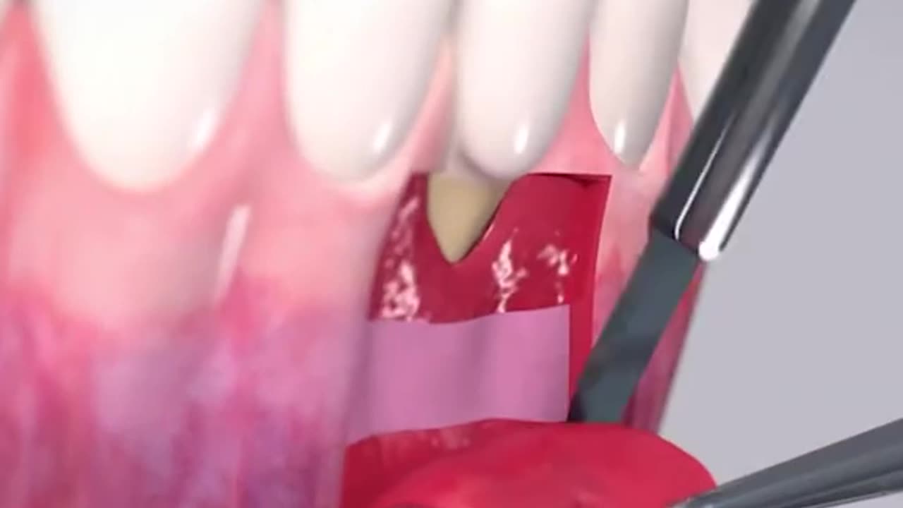 Root Coverage Of A Single Recession Deffect 3D Animation