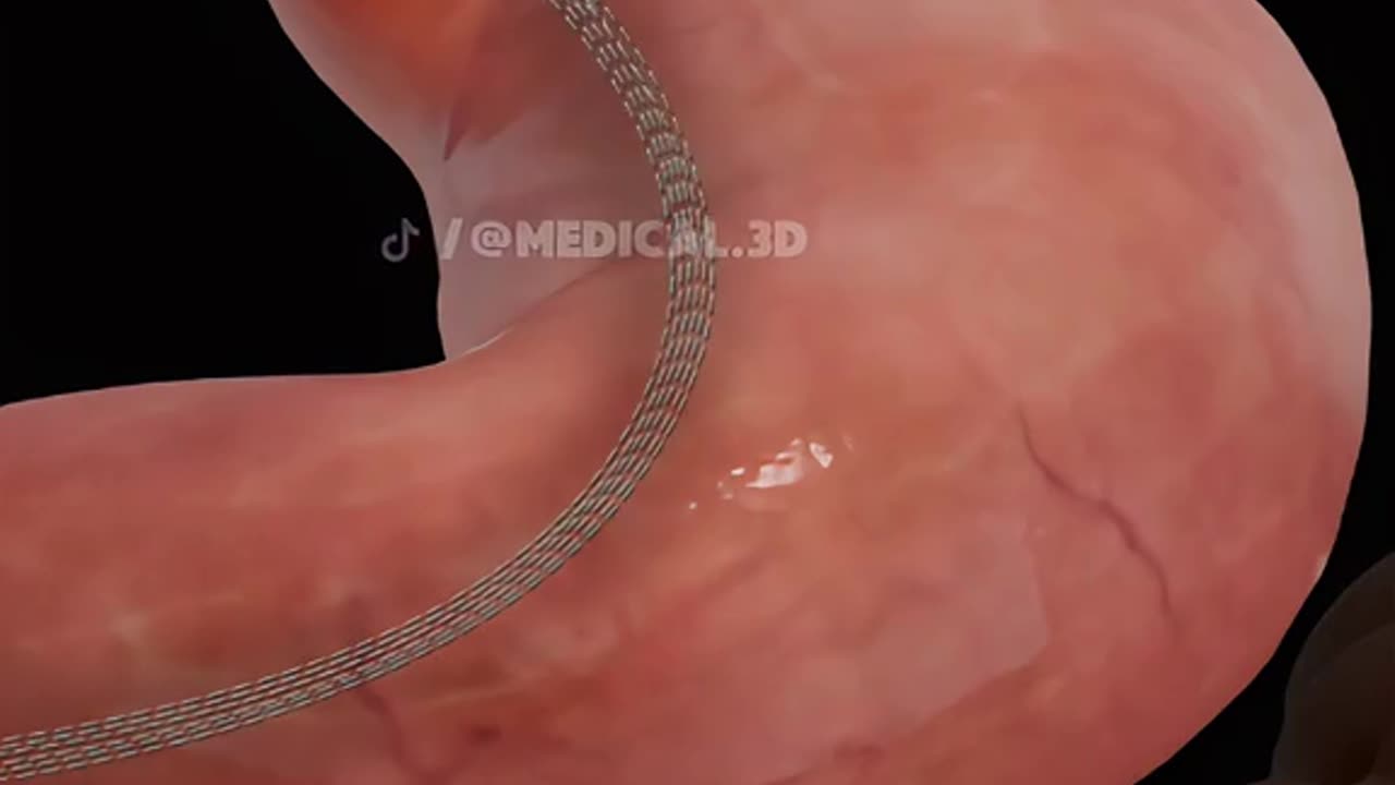 Sleeve Gastrectomy Surgery (3D Animation)