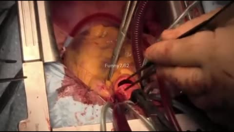 Heart Transplantation