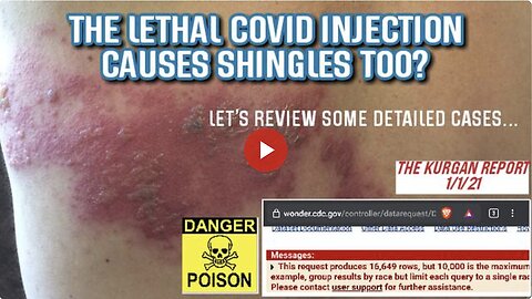 "Discoveries from Searching 'Shingles_' in VAERS COVID Injections Report"