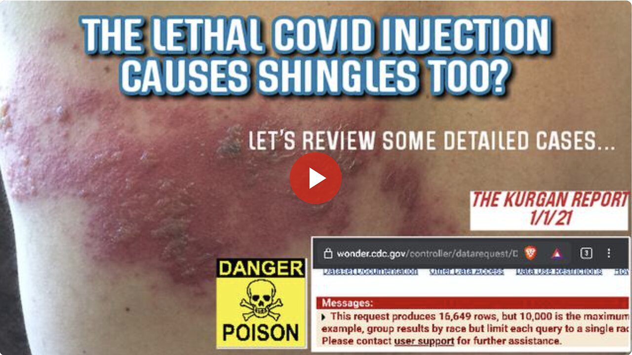"Discoveries from Searching 'Shingles_' in VAERS COVID Injections Report"