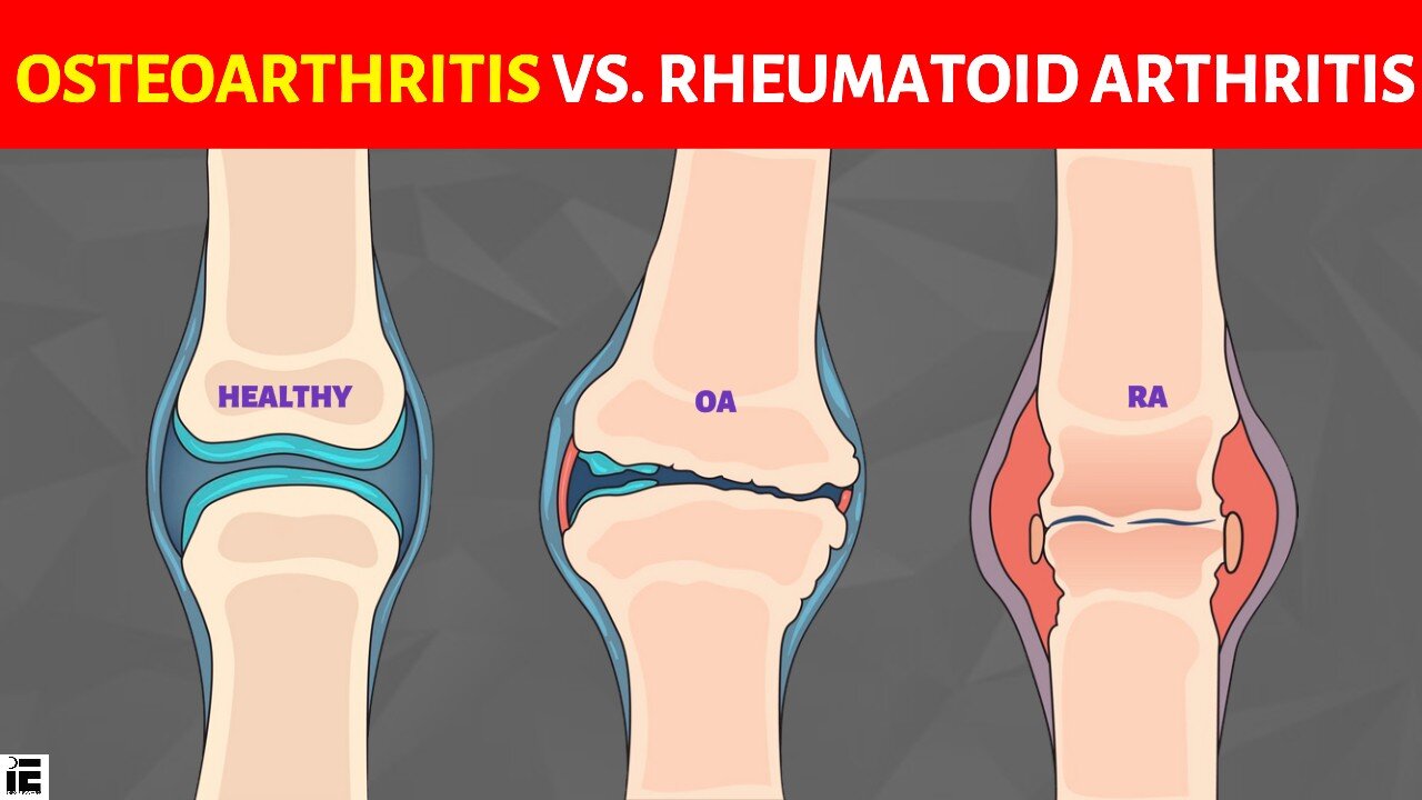 Understanding Arthritis: Osteoarthritis vs. Rheumatoid Arthritis