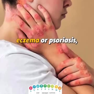 Skin issues? Eczema?