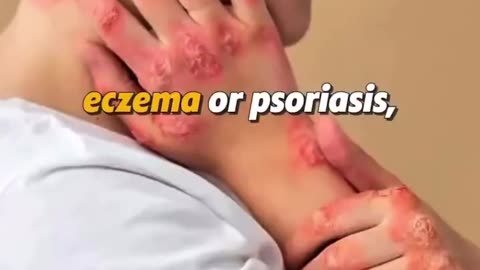 Skin issues? Eczema?