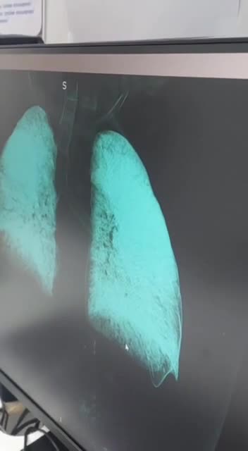 Chest X-Ray of Russians Pulled From Disused Oil Pipeline After Days of Breathing Oil Fumes