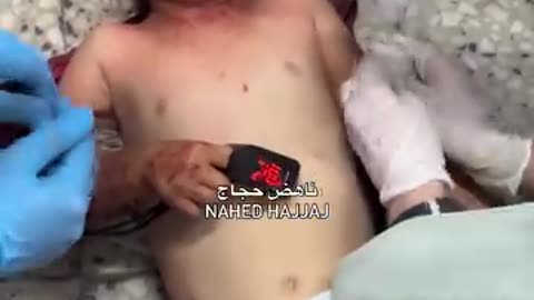 A child was seriously injured and arrived at Al-Shifa Hospital after his family's home was targeted