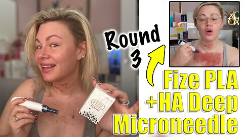 Fize PLA + HA Deep Microneedle, Round 3! AceCosm.com and code Jessica10 Saves