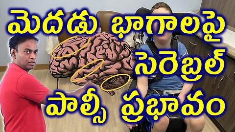 సెరెబ్రల్ పాల్సీ ఎఫెక్ట్, Brain Structure & Cerebral Palsy Effect On Child Brain Disorder Homeopathy