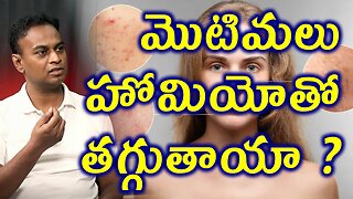 మొటిమలు హోమియోతో తగ్గుతాయా? Homeopathy Medicine Cure for Pimples Dry Skin Treatment Solution Clinic