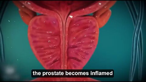 How To Reduce Enlarged Prostates Without Surgery