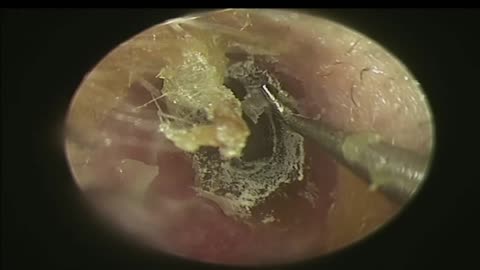 BIGGEST Ear Wax, Difficult Removal - EP3
