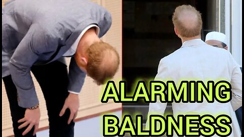 Prince Harry’s FIGHT Against His BALDING Hairline