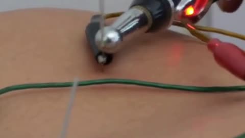 Relieve Pain Naturally with Dry Needling Therapy at Sri Sai Physiotherapy, Madurai