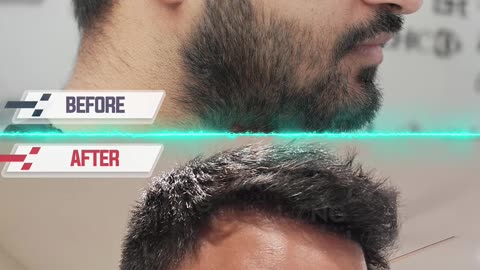 Hair transplant = life-changing results, confidence boost, and a fresh new look!