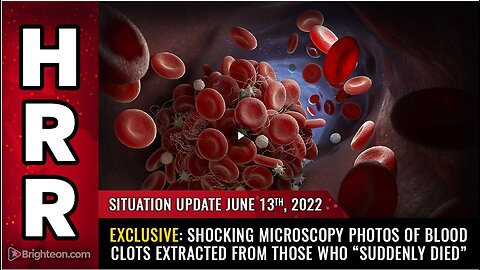 "Exclusive: Microscopic Images of Fibrous Clots from Sudden Death Victims"