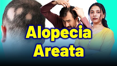 Alopecia Areata, Patchy hair loss, Spot baldness. |Treatment & Cure| Homeopathy, Medicine & Surgery