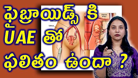 ఫైబ్రాయిడ్స్ కి UAE తో ఫలితం ఉందా?Best Treatment for Fibroids Uterine Artery Embolization (UAE)