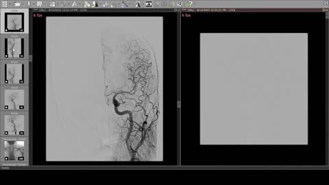 Catheter Angiogram of the venous system on Radiant Dicom Viewer - IJV compression