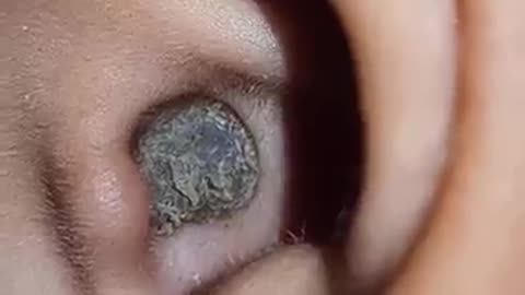 Amazing: Satisfying relaxing asmr earclining earwax removal