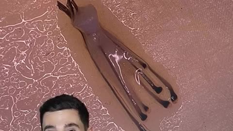 Incredible find during a recent hair transplant: 6 hair follicles in a single graft!