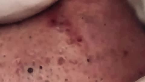 Blackheads Removal | Acne Treatment and Very Satisfying Satisfying Pimple pop (ASMR) #3 #blackheads