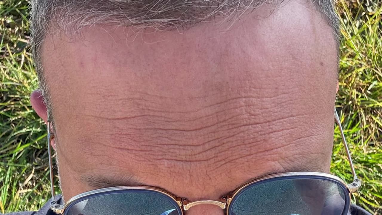 For those curious about how long it takes to see results after a hair transplant.