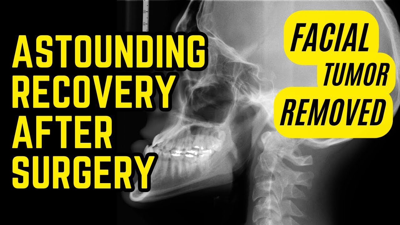 Miraculous recovery after facial tumor removal - How TST helped